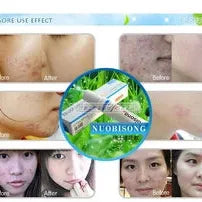 Hot! Nuobisong face care acne scar removal cream Acne Spots skin care treatment whitening face cream stretch marks moisturizing