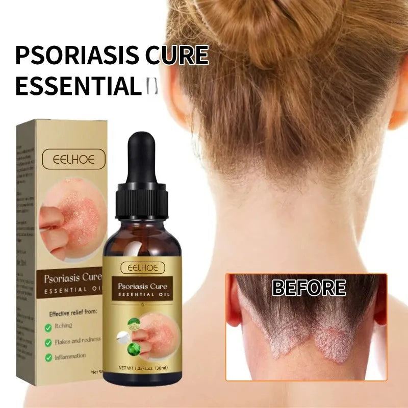 Psoriasis essential oil skin moss repair Hand Foot Dermatitis Eczema Antibacterial Anti Itching swelling relief Rash Care Serum