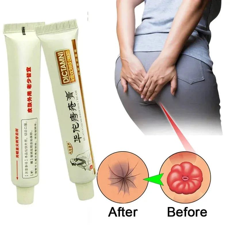 Hemorrhoids Removal Cream External Hemorrhoid Treatment Ointment Relief Cure Anal Fissure Anus Swell Bleed Relief Plaster