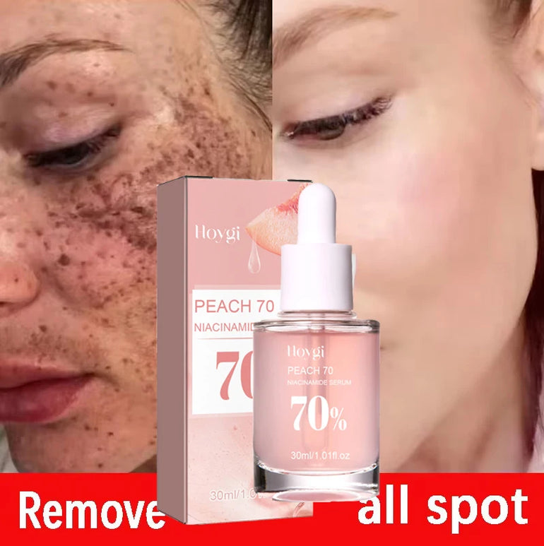 Niacinamide Whitening Freckles Serum Removal Melasma Dark Spots Lighten Melanin Pigmentation Brightening Anti-Aging Beauty Care