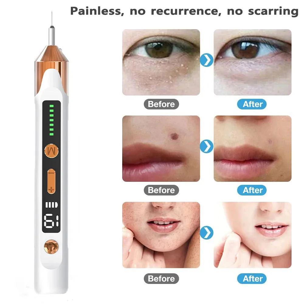 Skin Tag Remover Laser Plasma Pen Mole Wart Remover Pen Electric Tattoo Freckle Nevus Pimples Blemish Skin Tag Removal