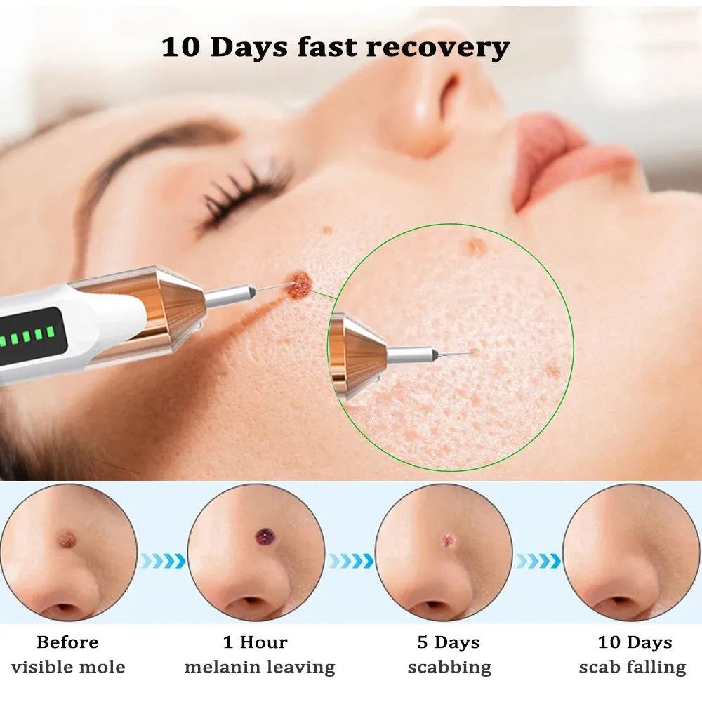 Skin Tag Remover Laser Plasma Pen Mole Wart Remover Pen Electric Tattoo Freckle Nevus Pimples Blemish Skin Tag Removal