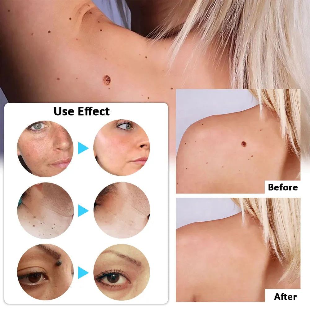 Plasma Laser Pen Skin Tag Remover Wart Mole Spots Freckles Dark Dpot Black Dots Nevus Flat Blemish Pimples Wart Eliminator