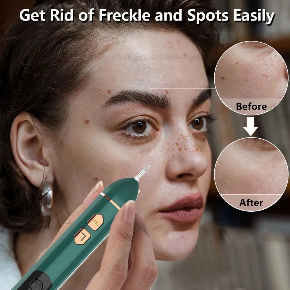 Plasma Laser Pen Skin Tag Remover Wart Mole Spots Freckles Dark Dpot Black Dots Nevus Flat Blemish Pimples Wart Eliminator